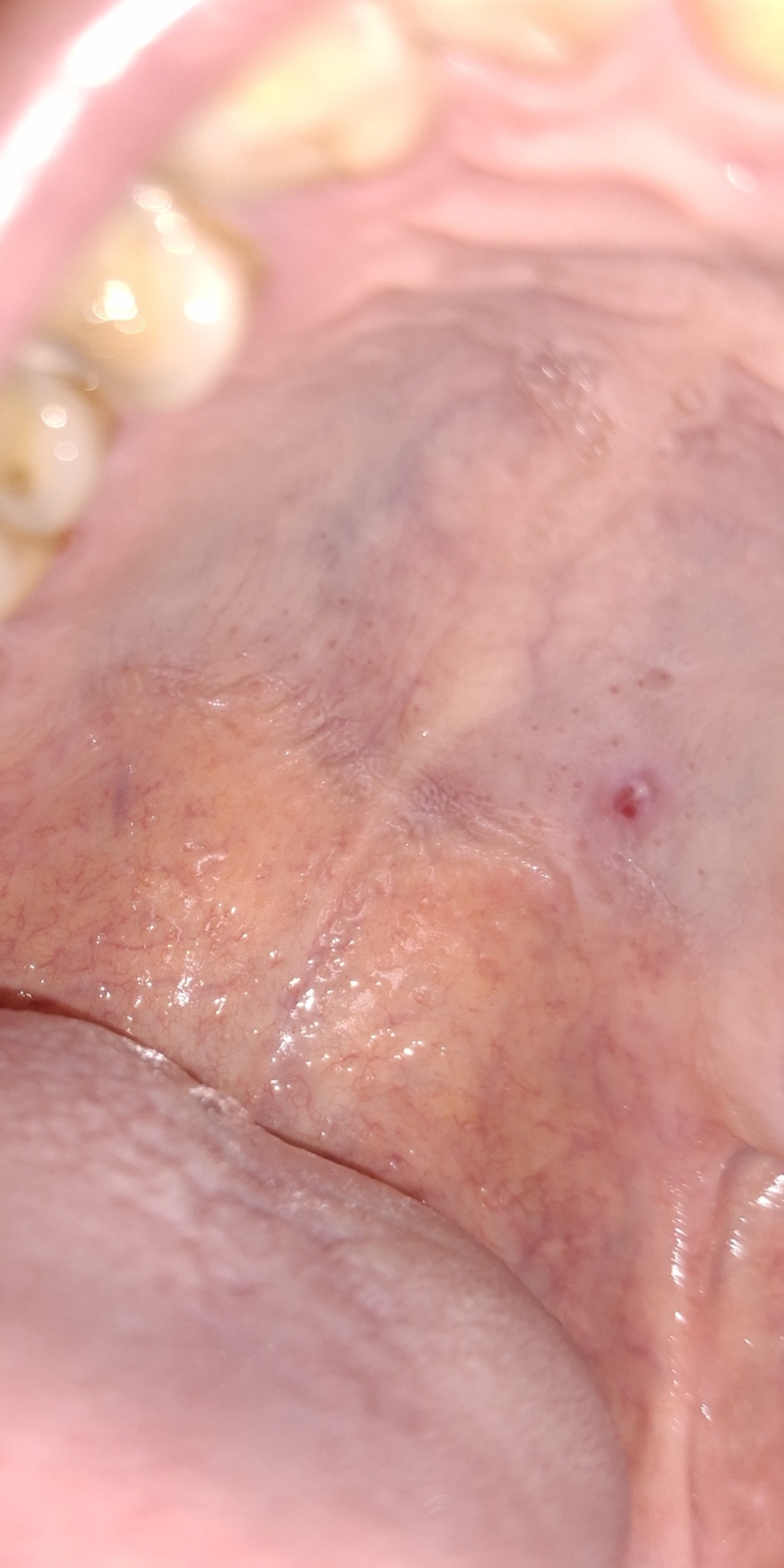 China PLA MSS communist nano-biochem parasite intentional contamination that grew into vagus nerve and into brain, then started to feed through tubules into mouth to then grow and try to take over my God given body.